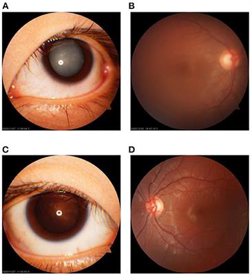 Case Report: A Novel Missense Variant in the SIPA1L3 Gene Associated With Cataracts in a Chinese Family